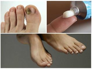fungal nail treatment
